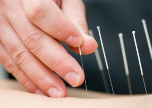 Acupuncture Hands Needles